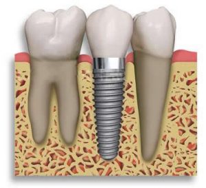 implantes dentales