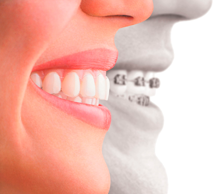 Tecnologia Invisalign Coadental